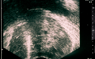 TRANSREKTAL PROSTAT BİYOPSİSİ (TRUS BİYOPSİ)