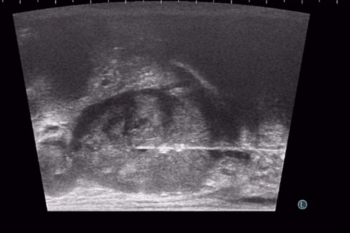 TRANSPERİNEAL PROSTAT BİYOPSİSİ (TEMİZ PROSTAT BİYOPSİSİ)