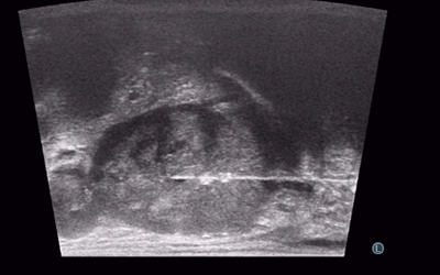 TRANSPERİNEAL PROSTAT BİYOPSİSİ (TEMİZ PROSTAT BİYOPSİSİ)