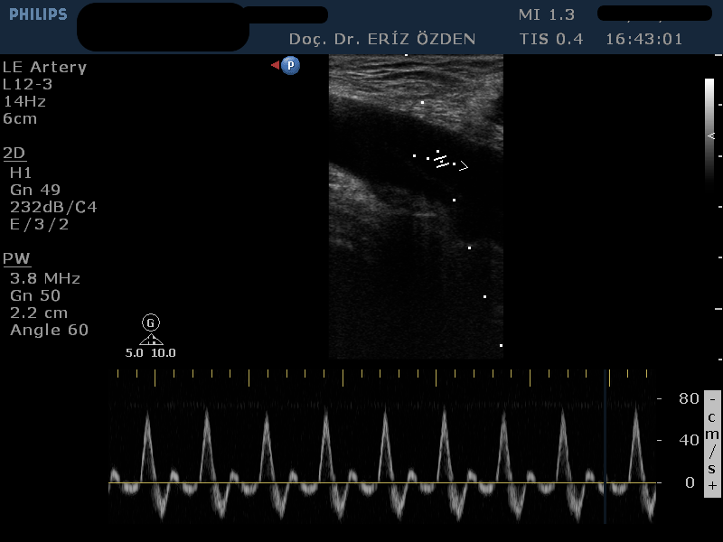 Alt Ekstremite Arteriel Renkli Doppler Ultrasonografi