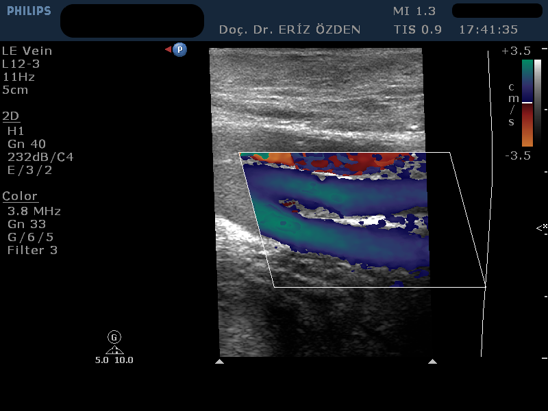 Alt Ekstremite Venöz Renkli Doppler Ultrasonografi