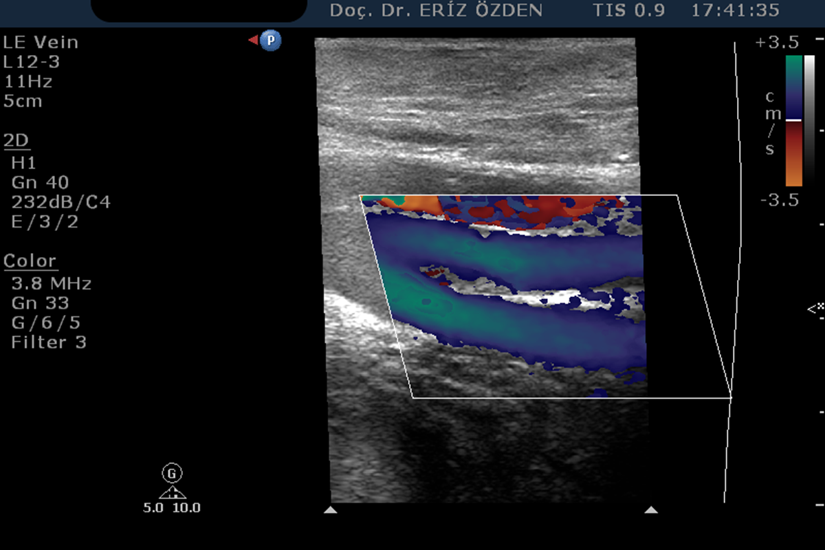 Alt Ekstremite Venöz Renkli Doppler Ultrasonografi