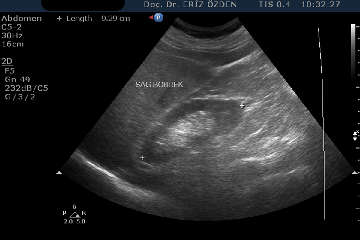 Renal Ultrasonografi