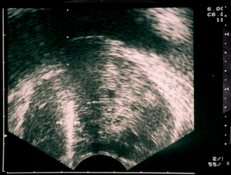 Transrektal Prostat Biyopsisi (TRUS biyopsi) 