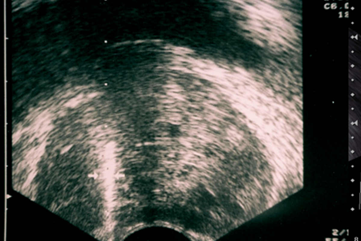 Transrektal Prostat Biyopsisi (TRUS biyopsi)