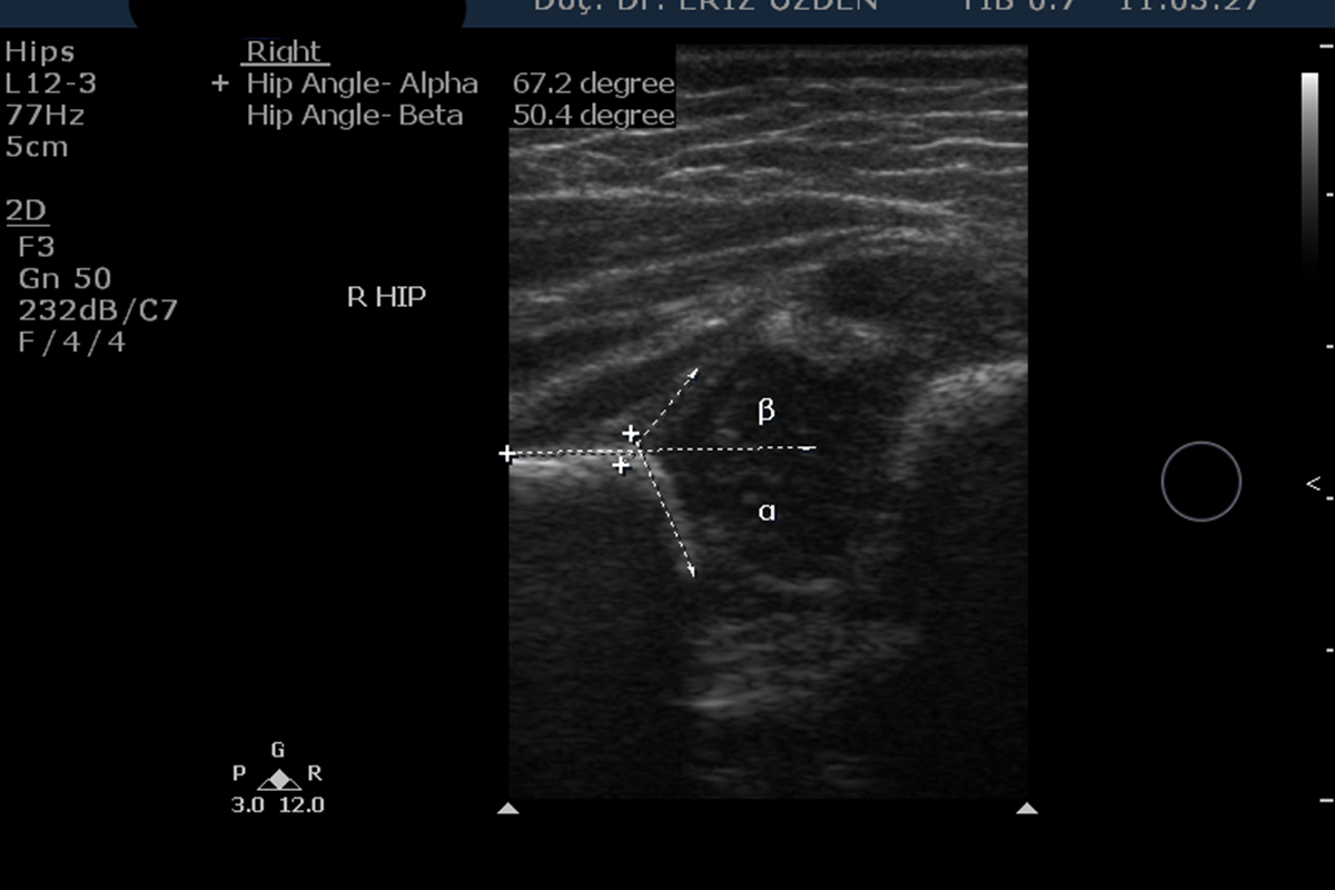 Kalça Ultrasonografisi