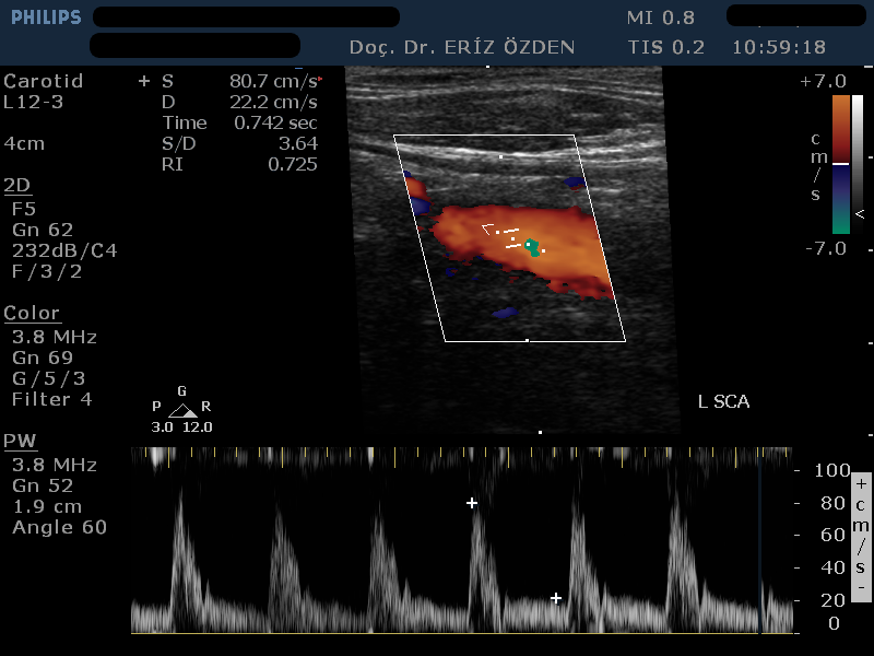 Karotis Renkli Doppler Ultrasonografi