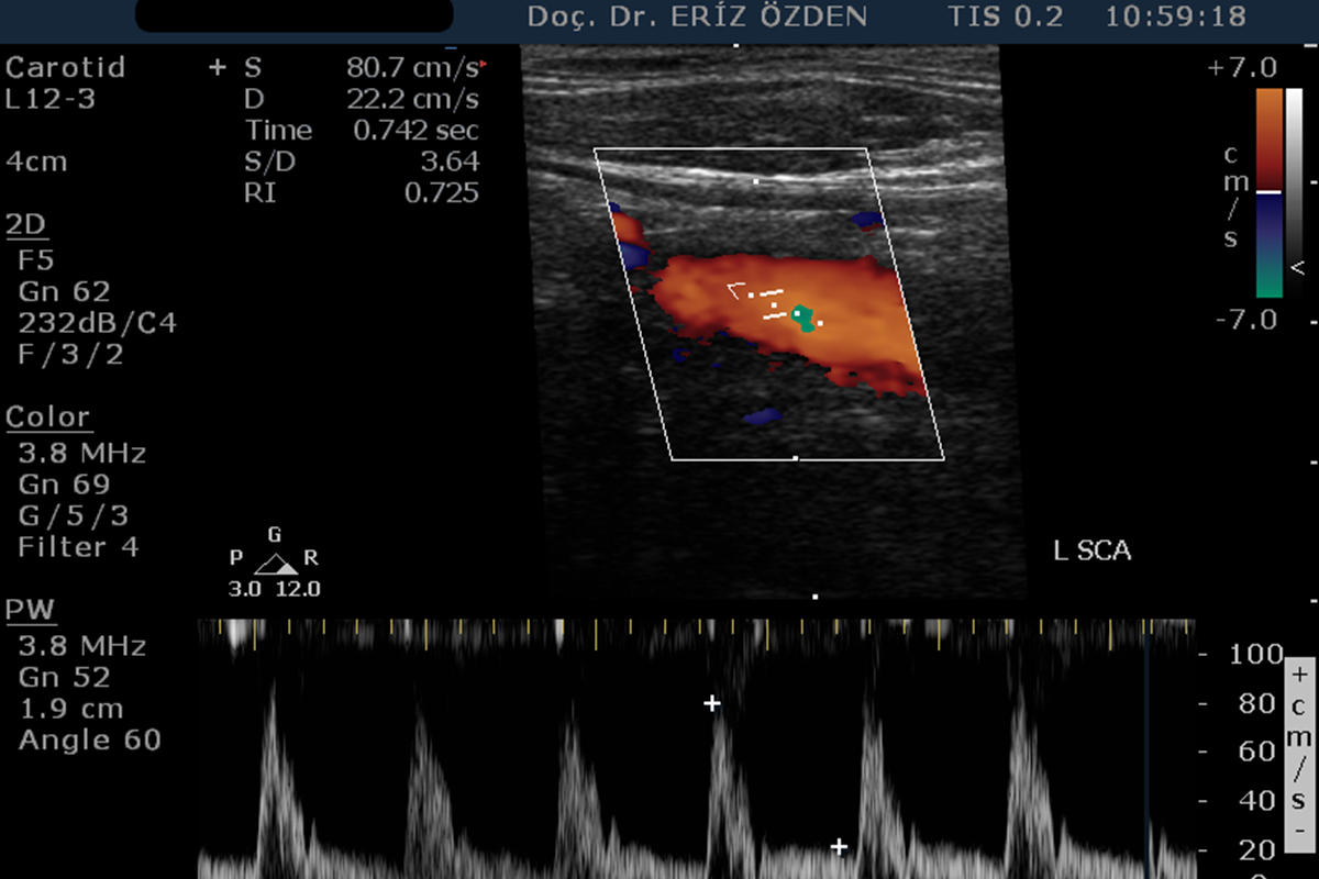 Karotis Renkli Doppler Ultrasonografi