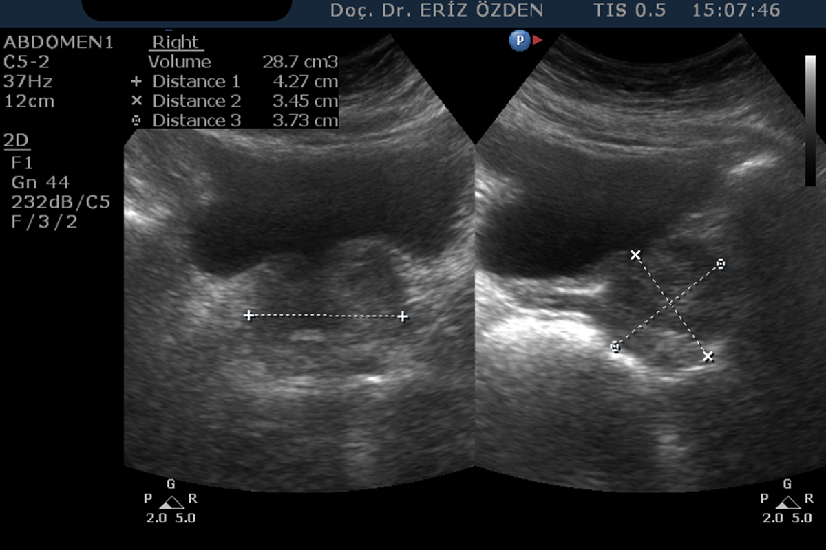 Pelvik Ultrasonografi