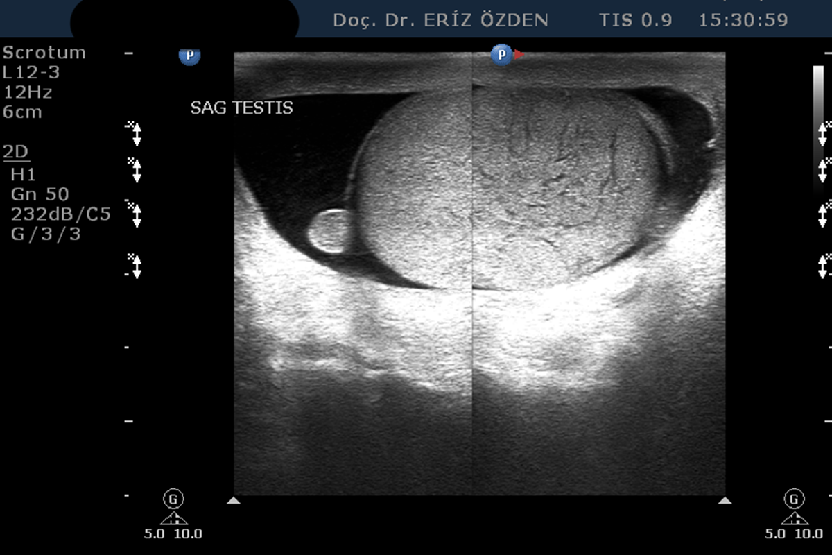 Skrotal Ultrasonografi