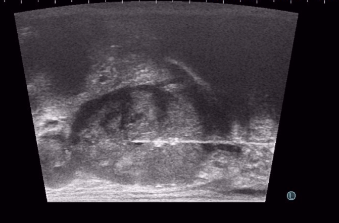 TRANSPERİNEAL PROSTAT BİYOPSİSİ (Temiz Prostat Biyopsisi)